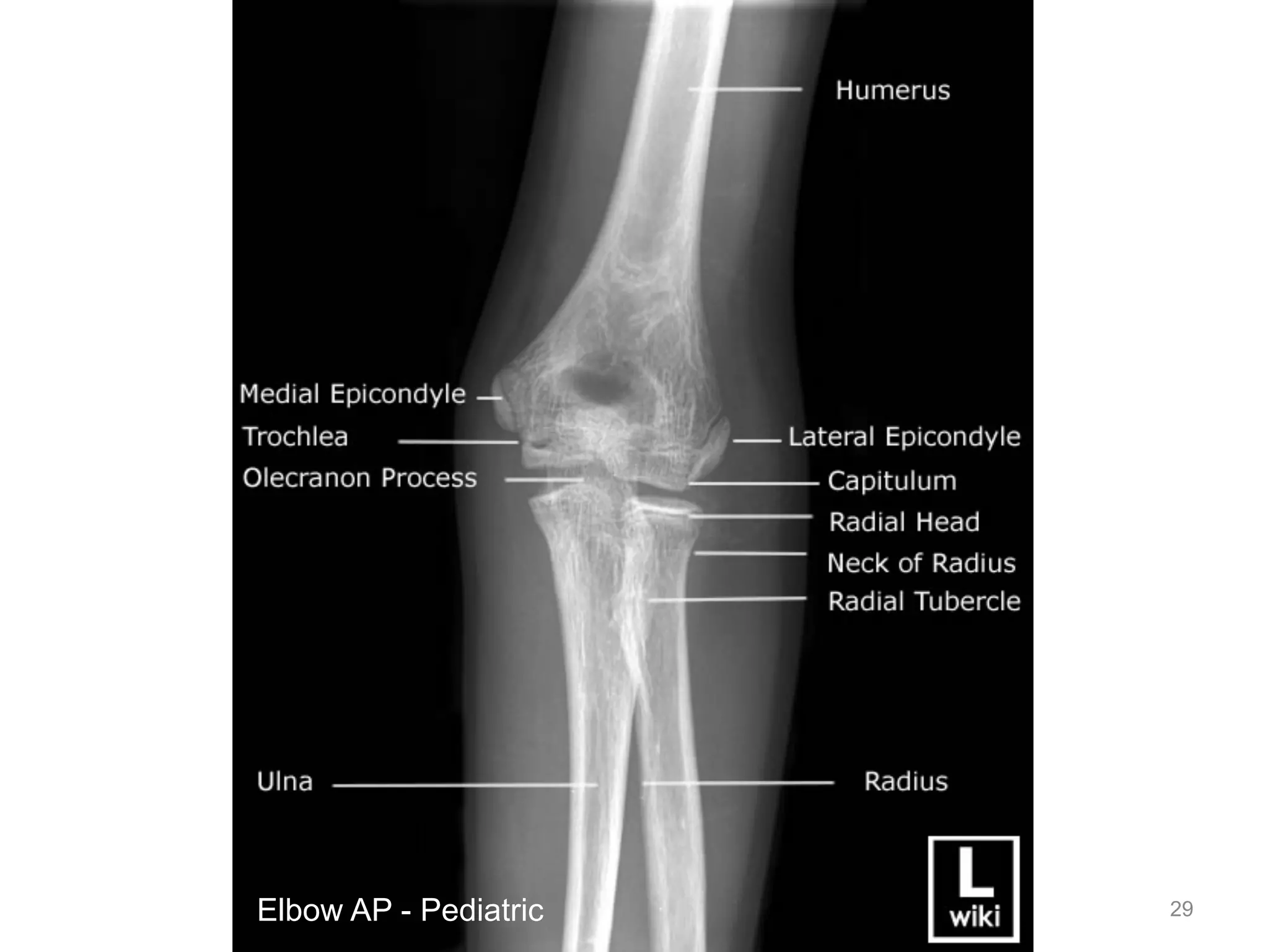Emergency Radiology: Shoulder & Upper Extremities | PDF
