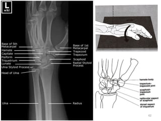 Emergency Radiology: Shoulder & Upper Extremities | PDF