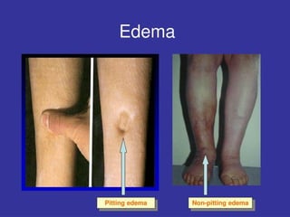 edema