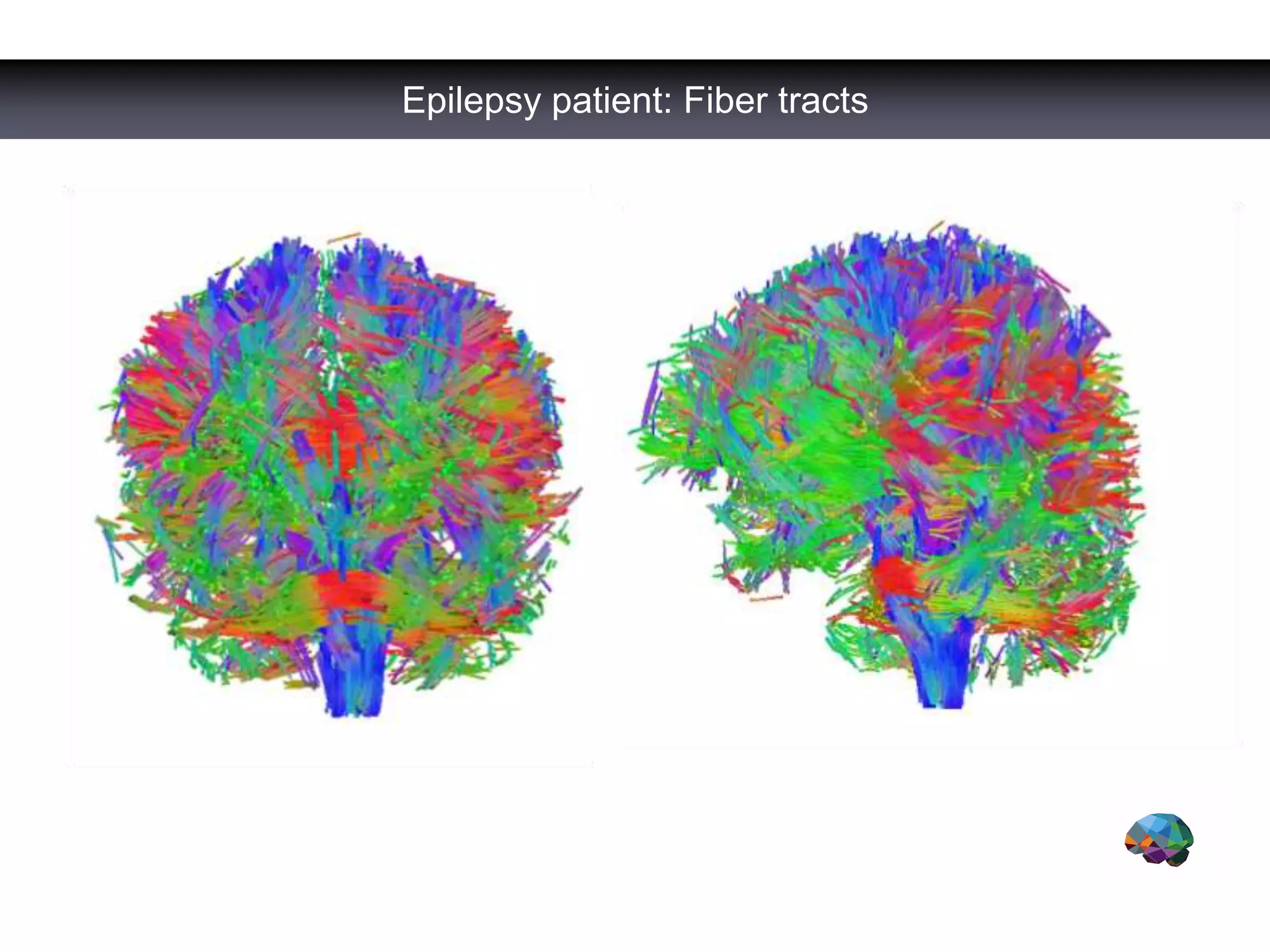 Epilepsy patient: Fiber tracts
 