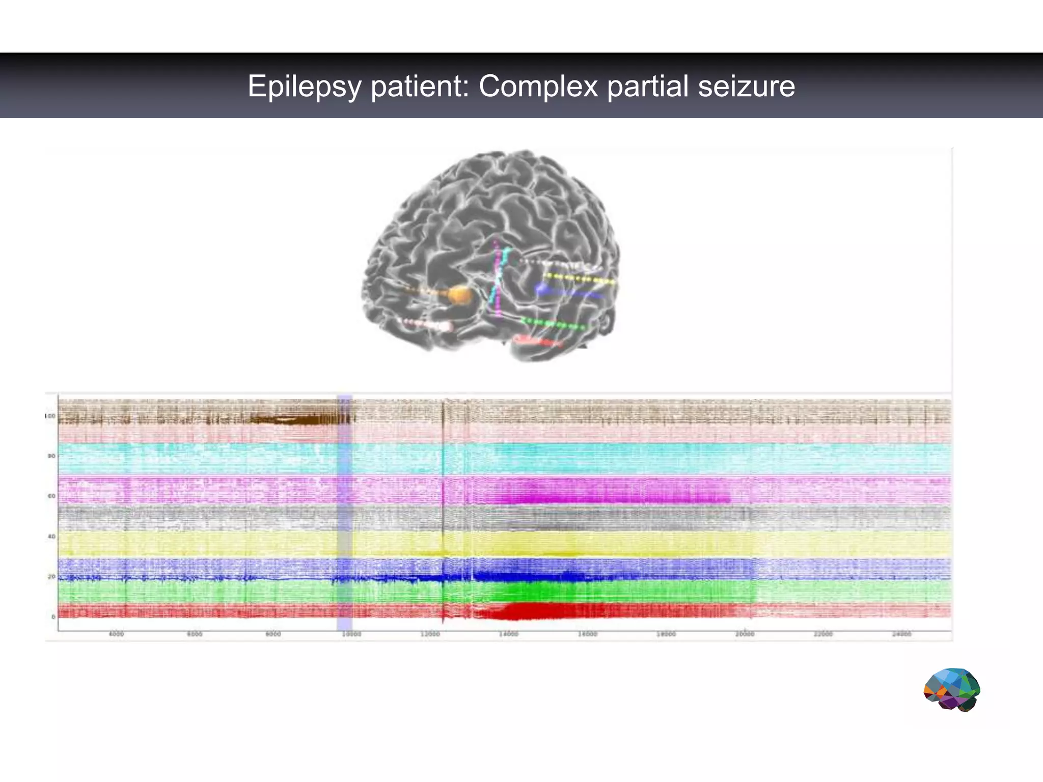 Epilepsy patient: Complex partial seizure
 