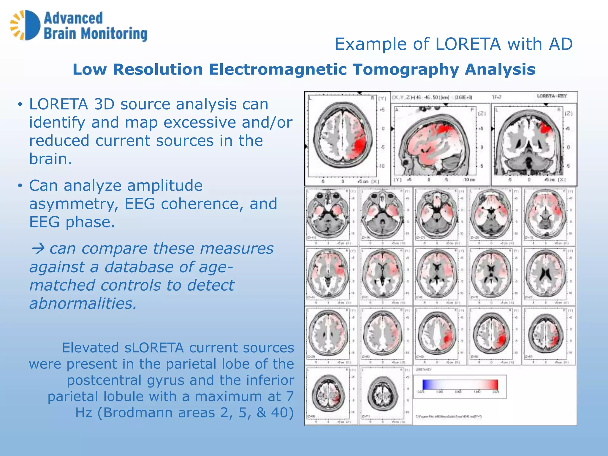 Low Resolution Electromagnetic Tomography Analysis
• LORETA 3D source analysis can
identify and map excessive and/or
reduced current sources in the
brain.
• Can analyze amplitude
asymmetry, EEG coherence, and
EEG phase.
 can compare these measures
against a database of age-
matched controls to detect
abnormalities.
Elevated sLORETA current sources
were present in the parietal lobe of the
postcentral gyrus and the inferior
parietal lobule with a maximum at 7
Hz (Brodmann areas 2, 5, & 40)
Example of LORETA with AD
 