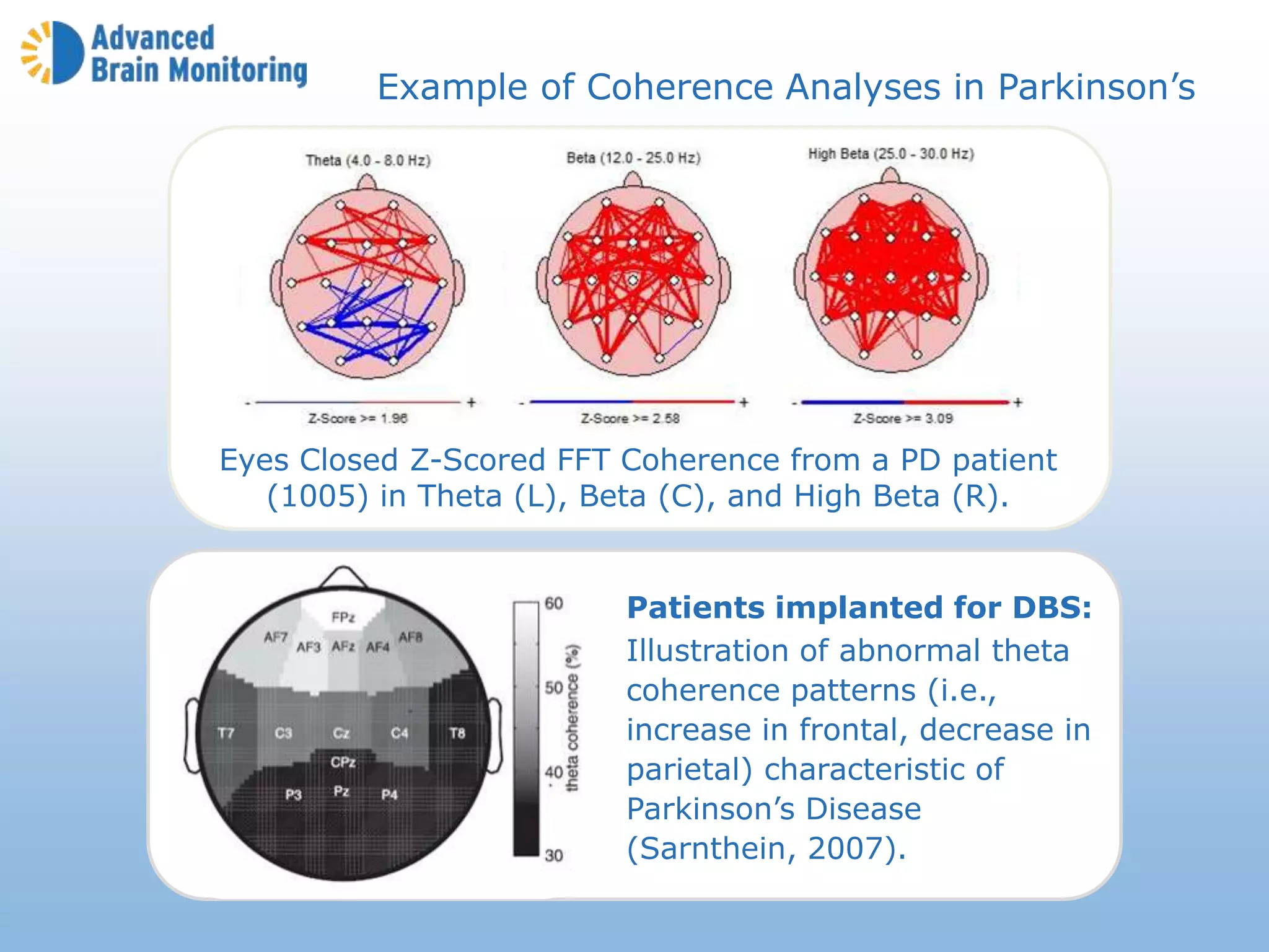 Example of Coherence Analyses in Parkinson’s
Patients implanted for DBS:
Illustration of abnormal theta
coherence patterns (i.e.,
increase in frontal, decrease in
parietal) characteristic of
Parkinson’s Disease
(Sarnthein, 2007).
Eyes Closed Z-Scored FFT Coherence from a PD patient
(1005) in Theta (L), Beta (C), and High Beta (R).
 