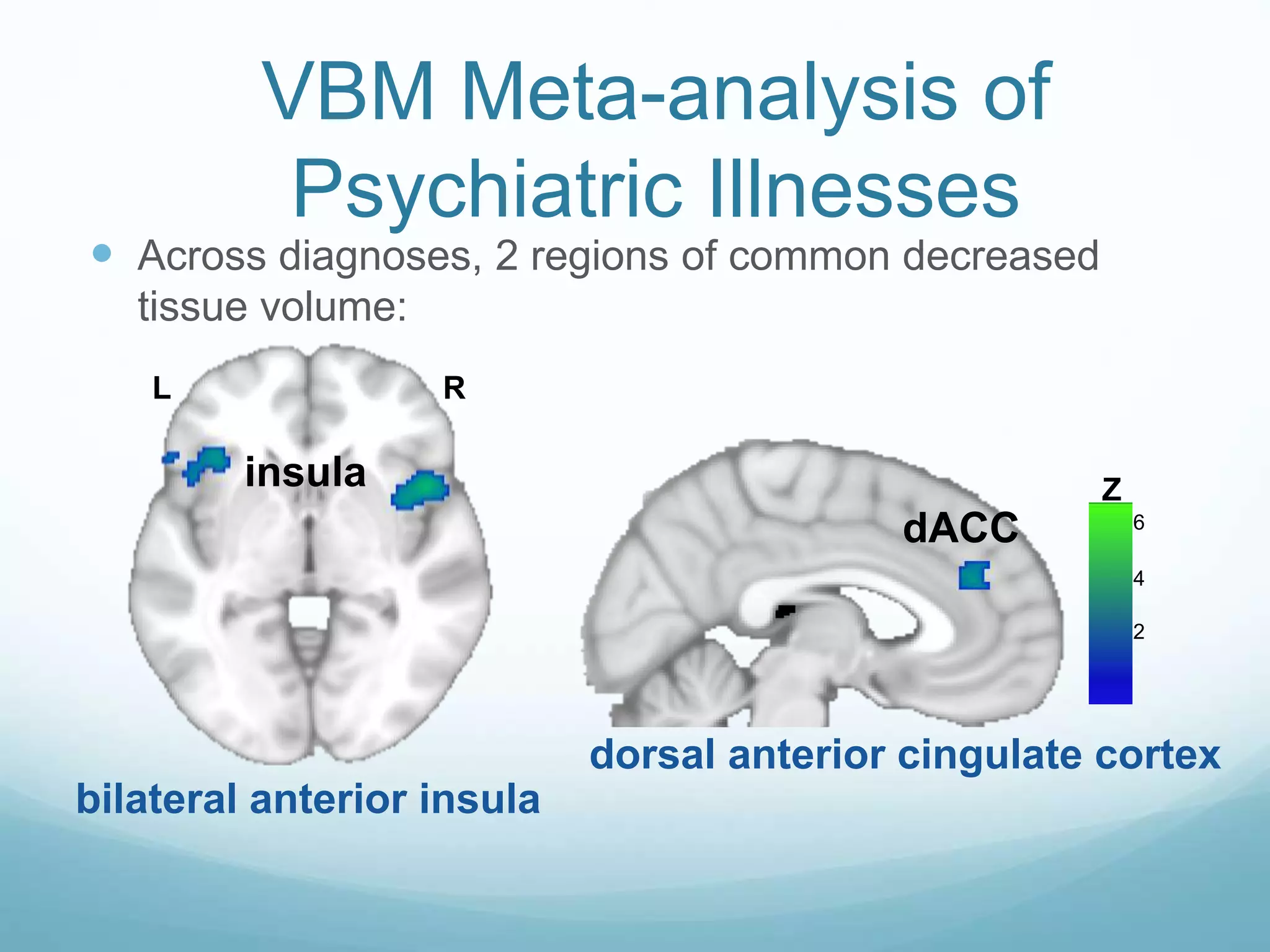  Across diagnoses, 2 regions of common decreased
tissue volume:
2
4
6
Z
dACC
RL
insula
VBM Meta-analysis of
Psychiatric Illnesses
bilateral anterior insula
dorsal anterior cingulate cortex
 