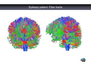 Epilepsy patient: Fiber tracts
 
