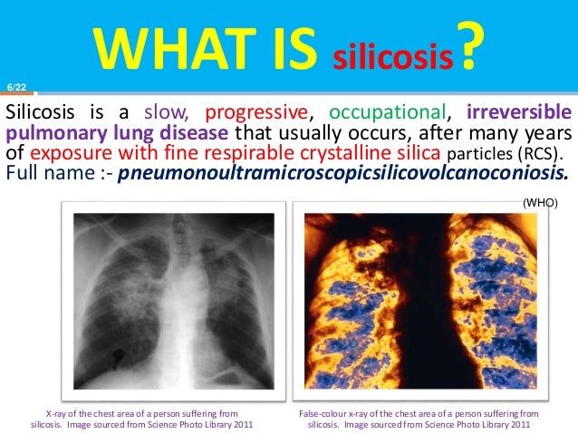2015 Pce5271lokeshsilicosis