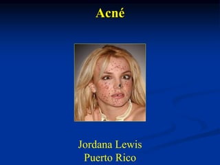 Jordana Lewis
Puerto Rico
Acné
 