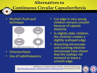 Alternatives to
Continuous Circular Capsulorrhexis
• Nischal’s Push-pull
technique
• Vitrectorrhexis
• Use of radiofrequency
• Cut edge in very young
children remains smooth
because of capsule
elasticity
• In slightly older children,
the vitrector creates a
slightly scalloped edge
• dissecting microscope
and scanning electron
microscope have shown
that the scallops roll
outward to leave a
smooth edge.
ME Wilson et al. Cataract Surgery in Children, Trends and Controversies.
http://www.aapos.org/client_data/files/2012/479_wilsonhandout.pdf Accessed August 23, 2015.
http://www.medicalmedia.co.il
 