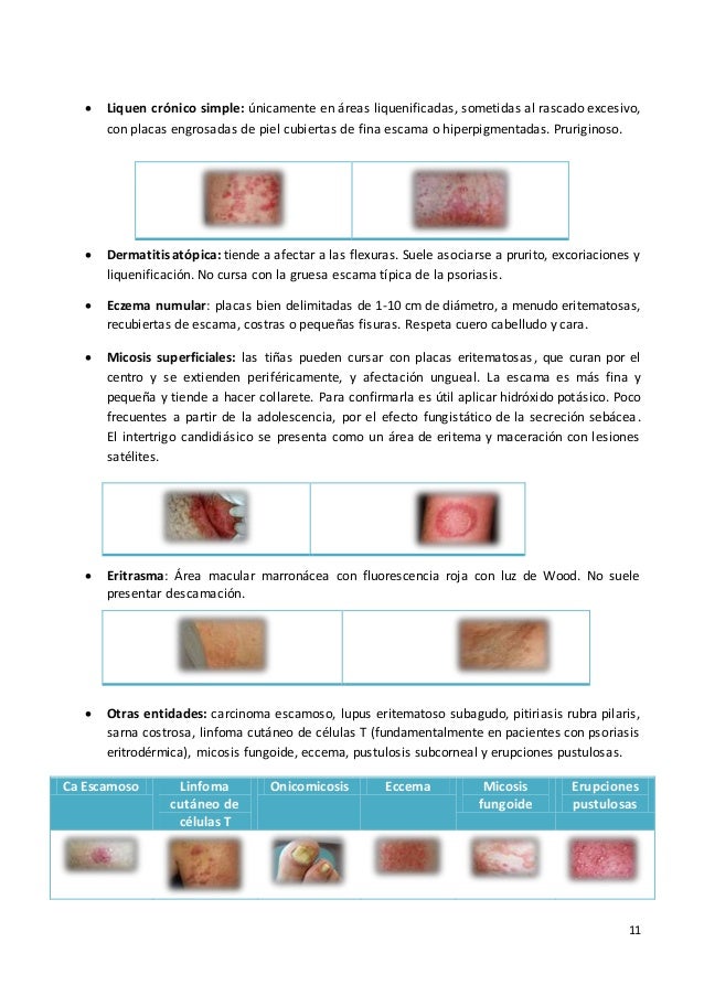 El ungüento de ictiol el tratamiento de la psoriasis