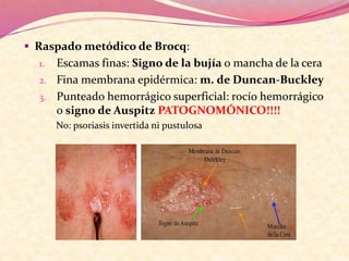  Raspado metódico de Brocq:
1. Escamas finas: Signo de la bujía o mancha de la cera
2. Fina membrana epidérmica: m. de Duncan-Buckley
3. Punteado hemorrágico superficial: rocío hemorrágico
o signo de Auspitz PATOGNOMÓNICO!!!!
No: psoriasis invertida ni pustulosa
 