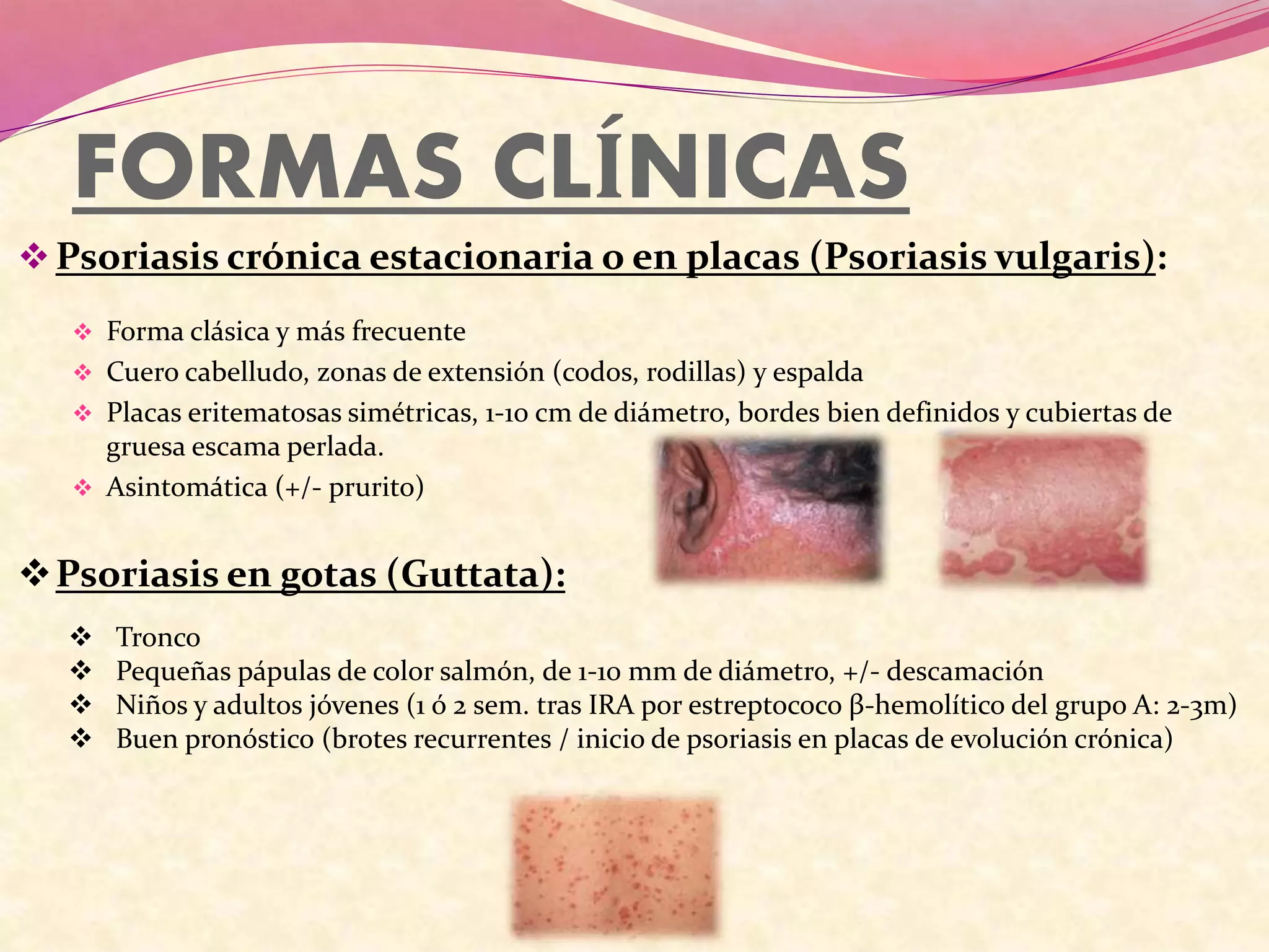 FORMAS CLÍNICAS
Psoriasis crónica estacionaria o en placas (Psoriasis vulgaris):
 Forma clásica y más frecuente
 Cuero cabelludo, zonas de extensión (codos, rodillas) y espalda
 Placas eritematosas simétricas, 1-10 cm de diámetro, bordes bien definidos y cubiertas de
gruesa escama perlada.
 Asintomática (+/- prurito)
Psoriasis en gotas (Guttata):
 Tronco
 Pequeñas pápulas de color salmón, de 1-10 mm de diámetro, +/- descamación
 Niños y adultos jóvenes (1 ó 2 sem. tras IRA por estreptococo β-hemolítico del grupo A: 2-3m)
 Buen pronóstico (brotes recurrentes / inicio de psoriasis en placas de evolución crónica)
 