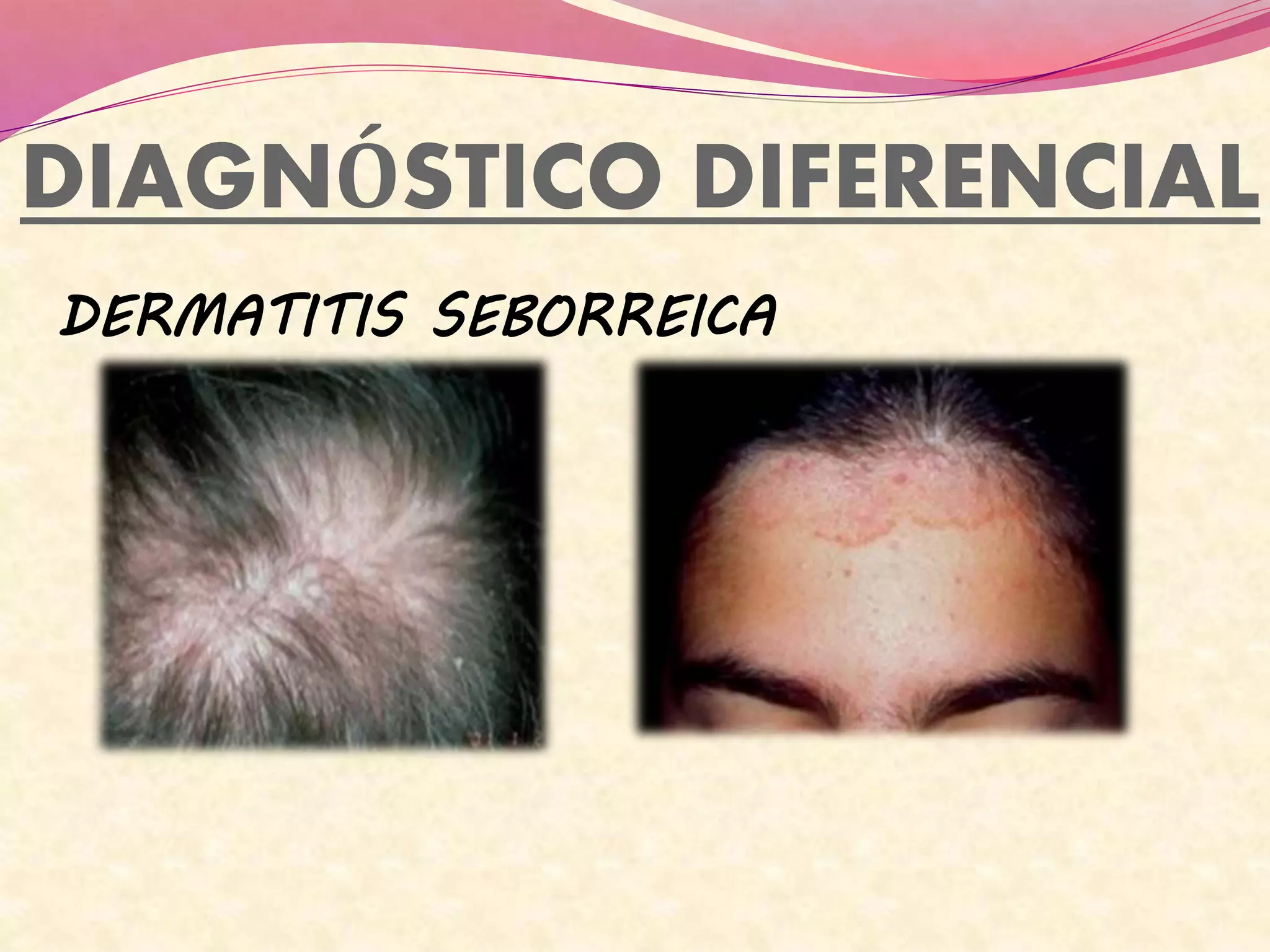 DIAGNÓSTICO DIFERENCIAL
DERMATITIS SEBORREICA
 