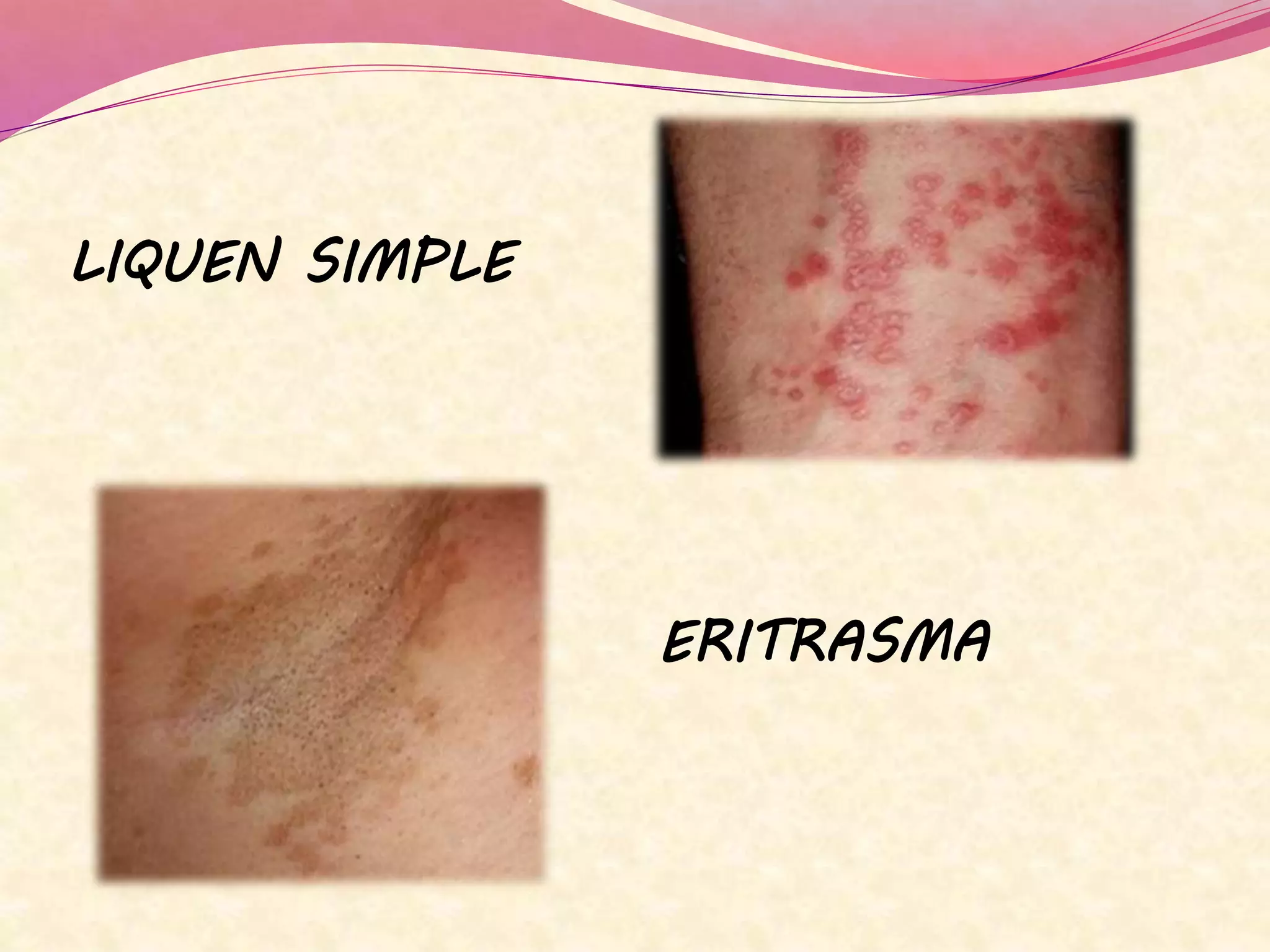 LIQUEN SIMPLE
ERITRASMA
 