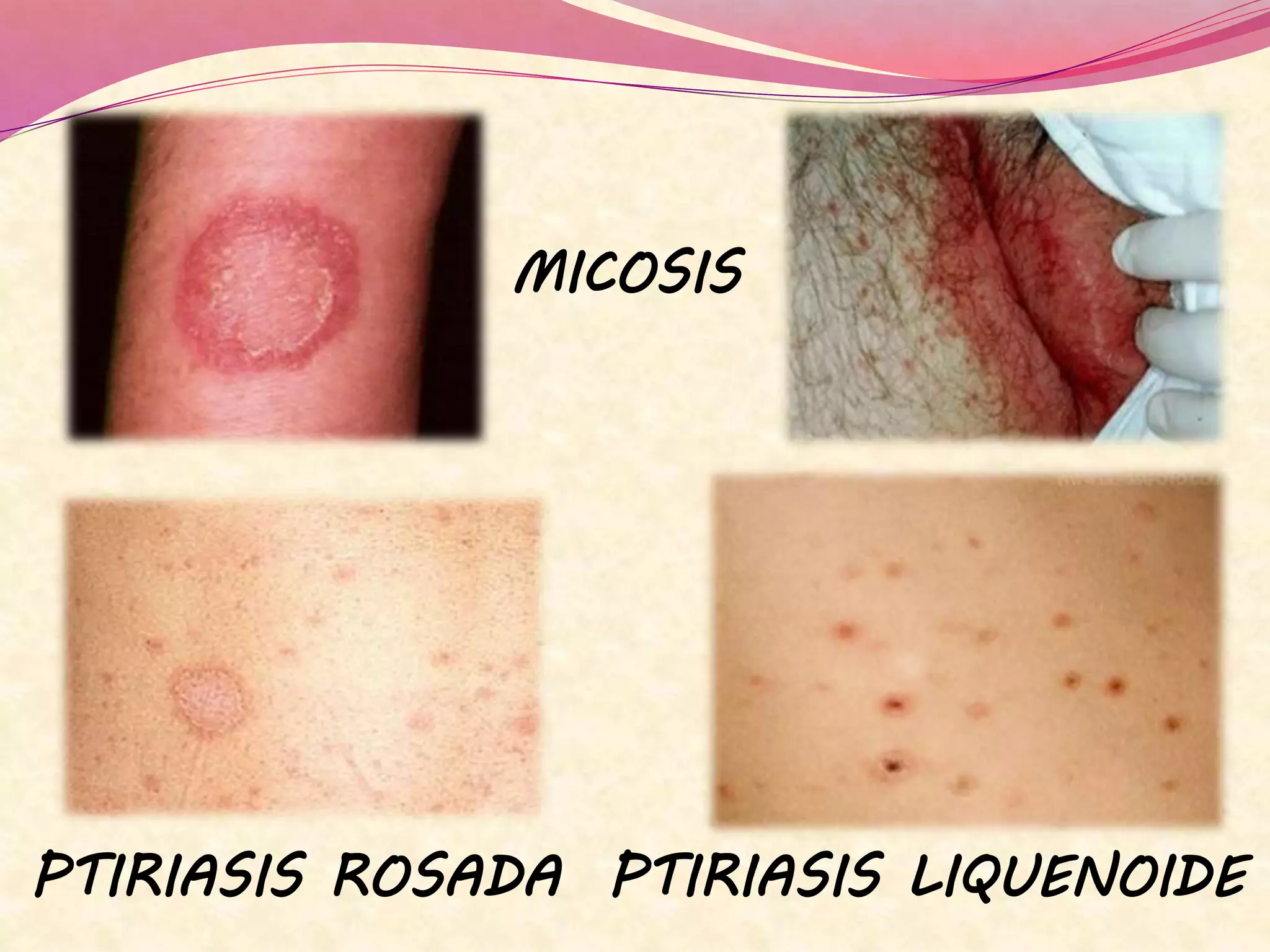 MICOSIS
PTIRIASIS ROSADA PTIRIASIS LIQUENOIDE
 