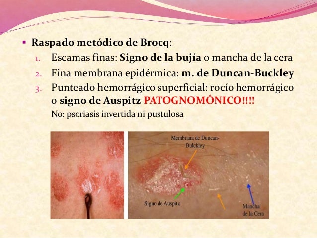 La crema antiinflamatoria de la psoriasis