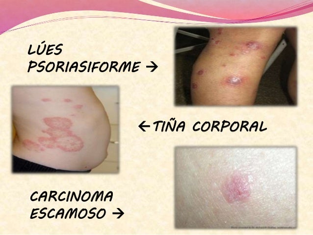 (2016 02-02)psoriasis(ppt)