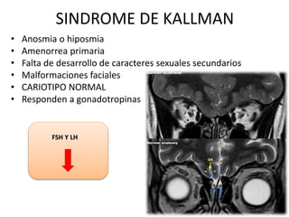SINDROME DE KALLMAN
• Anosmia o hiposmia
• Amenorrea primaria
• Falta de desarrollo de caracteres sexuales secundarios
• Malformaciones faciales
• CARIOTIPO NORMAL
• Responden a gonadotropinas
FSH Y LH
 