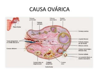 CAUSA OVÁRICA
 