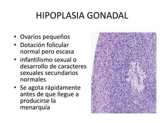 HIPOPLASIA GONADAL
• Ovarios pequeños
• Dotación folicular
normal pero escasa
• infantilismo sexual o
desarrollo de caracteres
sexuales secundarios
normales
• Se agota rápidamente
antes de que llegue a
producirse la
menarquía
 