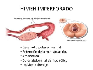HIMEN IMPERFORADO
• Desarrollo puberal normal
• Retención de la menstruación.
• Amenorrea
• Dolor abdominal de tipo cólico
• Incisión y drenaje
 