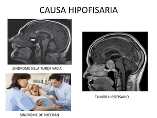 CAUSA HIPOFISARIA
SINDROME SILLA TURCA VACIA
SINDROME DE SHEEHAN
TUMOR HIPOFISARIO
 