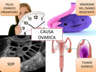 CAUSA
OVARICA
FALLO
OVÁRICO
PREMATURO
SÍNDROME
DEL OVARIO
RESISTENTE
SOP TUMOR
OVÁRICO
 