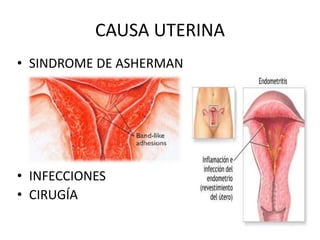 CAUSA UTERINA
• SINDROME DE ASHERMAN
• INFECCIONES
• CIRUGÍA
 
