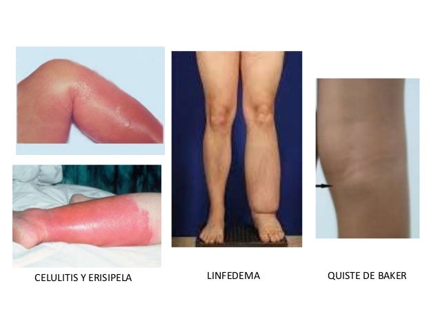 (2016 10-20)trombosis venosa profunda(ppt)