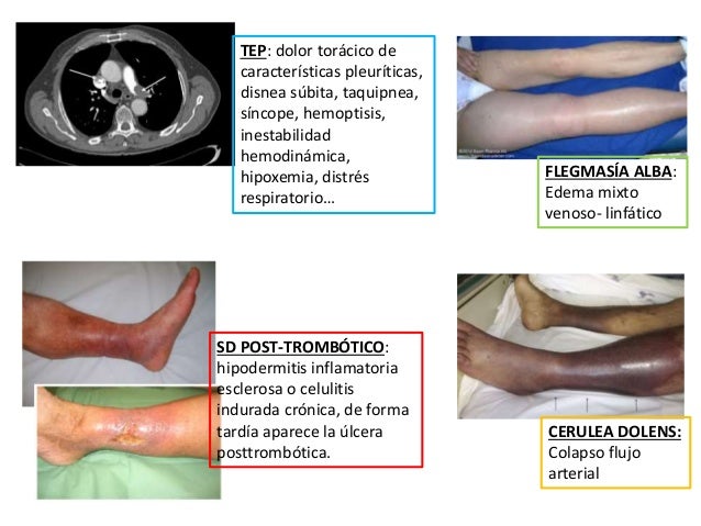 400 paracetamol profunda(ppt) venosa 20)trombosis (2016 10 400 paracetamol profunda(ppt) venosa 20)trombosis (2016 10
