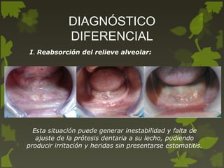 DIAGNÓSTICO
DIFERENCIAL
I. Reabsorción del relieve alveolar:
Esta situación puede generar inestabilidad y falta de
ajuste de la prótesis dentaria a su lecho, pudiendo
producir irritación y heridas sin presentarse estomatitis.
 