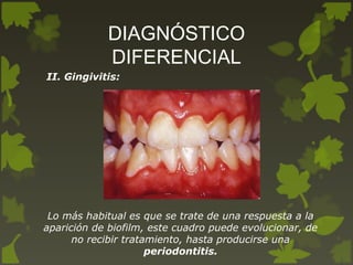 DIAGNÓSTICO
DIFERENCIAL
II. Gingivitis:
Lo más habitual es que se trate de una respuesta a la
aparición de biofilm, este cuadro puede evolucionar, de
no recibir tratamiento, hasta producirse una
periodontitis.
 