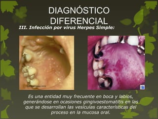 DIAGNÓSTICO
DIFERENCIAL
III. Infección por virus Herpes Simple:
Es una entidad muy frecuente en boca y labios,
generándose en ocasiones gingivoestomatitis en las
que se desarrollan las vesículas características del
proceso en la mucosa oral.
 