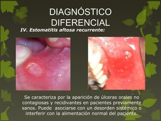 DIAGNÓSTICO
DIFERENCIAL
IV. Estomatitis aftosa recurrente:
Se caracteriza por la aparición de úlceras orales no
contagiosas y recidivantes en pacientes previamente
sanos. Puede asociarse con un desorden sistémico o
interferir con la alimentación normal del paciente.
 