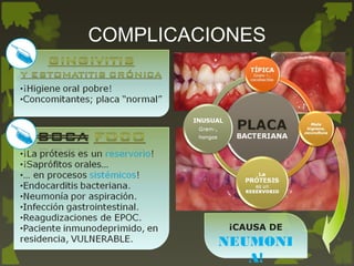 ¡CAUSA DE
NEUMONI
A!
COMPLICACIONES
 