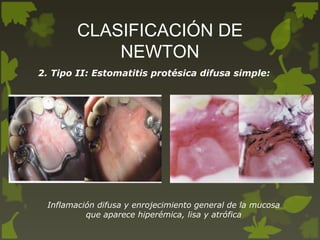 CLASIFICACIÓN DE
NEWTON
2. Tipo II: Estomatitis protésica difusa simple:
Inflamación difusa y enrojecimiento general de la mucosa
que aparece hiperémica, lisa y atrófica
 