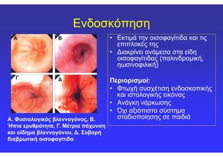 ΕνδοσκόπησηΕνδοσκόπηση
•• Εκτιμά την οισοφαγίτιδα και τιςΕκτιμά την οισοφαγίτιδα και τις
επιπλοκές τηςεπιπλοκές της
•• Διακρίνει ανάμεσα στα είδηΔιακρίνει ανάμεσα στα είδη
οισοφαγίτιδας (παλινδρομική,οισοφαγίτιδας (παλινδρομική,
ηωσινοφιλική)ηωσινοφιλική)
ΠεριορισμοίΠεριορισμοί::
ΑΑ ΒΒ
ΓΓ ΔΔ ΠεριορισμοίΠεριορισμοί::
•• Φτωχή συσχέτιση ενδοσκοπικήςΦτωχή συσχέτιση ενδοσκοπικής
και ιστολογικής εικόναςκαι ιστολογικής εικόνας
•• Ανάγκη νάρκωσηςΑνάγκη νάρκωσης
•• Όχι αξιόπιστο σύστημαΌχι αξιόπιστο σύστημα
σταδιοποίησης σε παιδιάσταδιοποίησης σε παιδιάΑ. Φυσιολογικός βλεννογόνος, Β.Α. Φυσιολογικός βλεννογόνος, Β.
Ήπια ερυθρότητα, ΓΉπια ερυθρότητα, Γ.. Μέτρια πάχυνσηΜέτρια πάχυνση
και οίδημα βλεννογόνου, Δκαι οίδημα βλεννογόνου, Δ.. ΣοβαρήΣοβαρή
διαβρωτική οισοφαγίτιδαδιαβρωτική οισοφαγίτιδα
ΓΓ ΔΔ
 