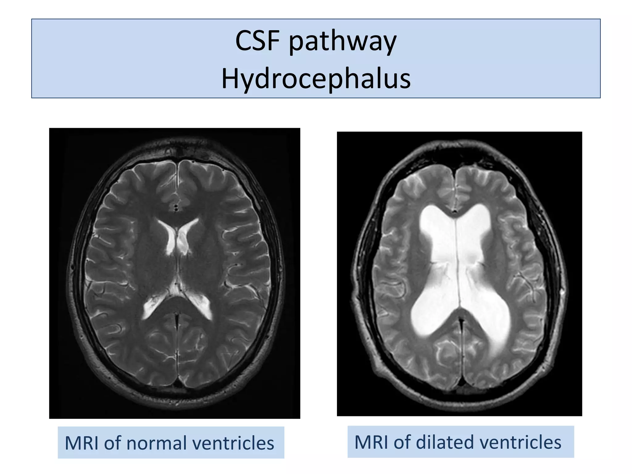CSF pathway
Hydrocephalus
MRI of normal ventricles MRI of dilated ventricles
 