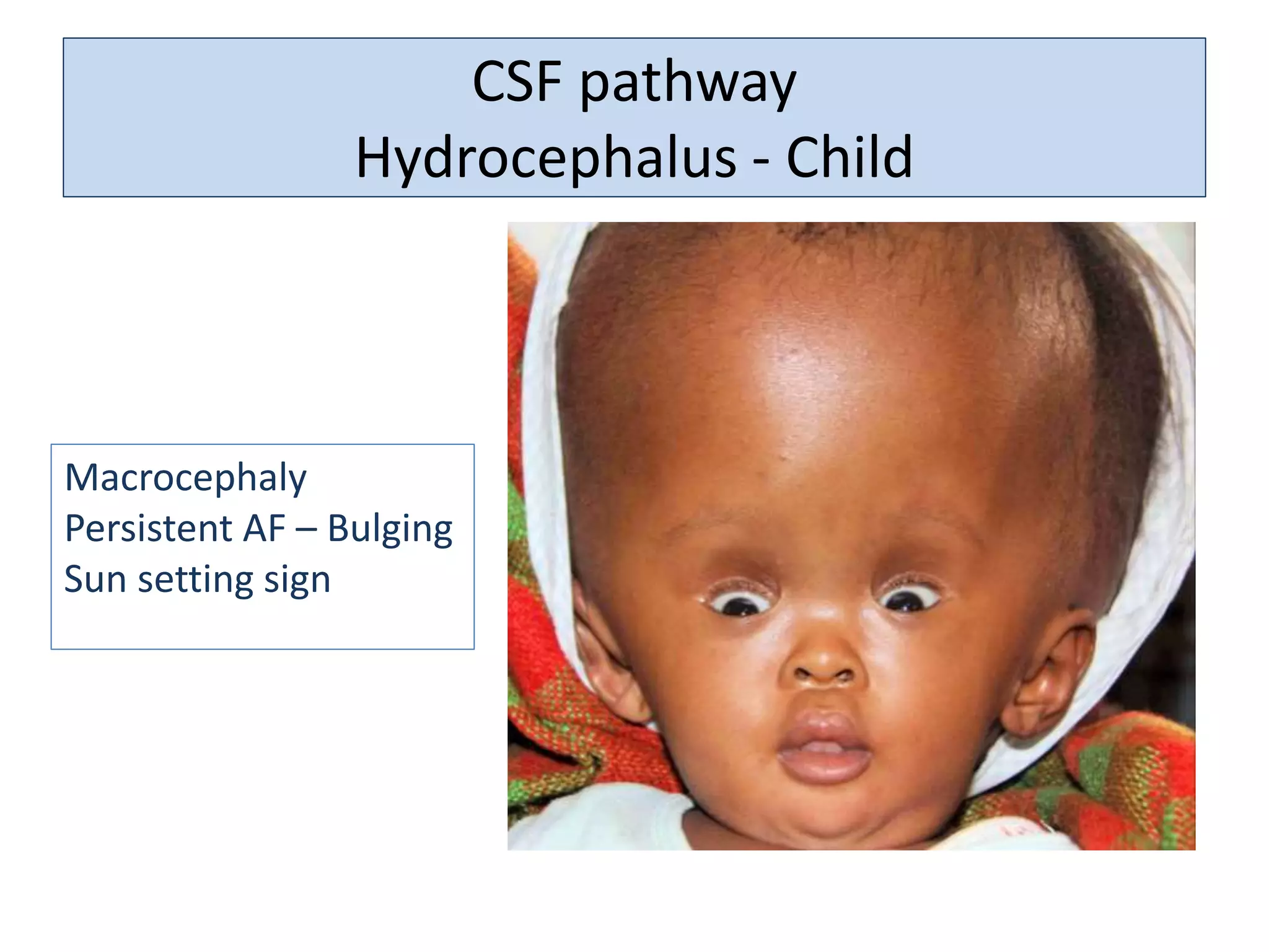 CSF pathway
Hydrocephalus - Child
Macrocephaly
Persistent AF – Bulging
Sun setting sign
 