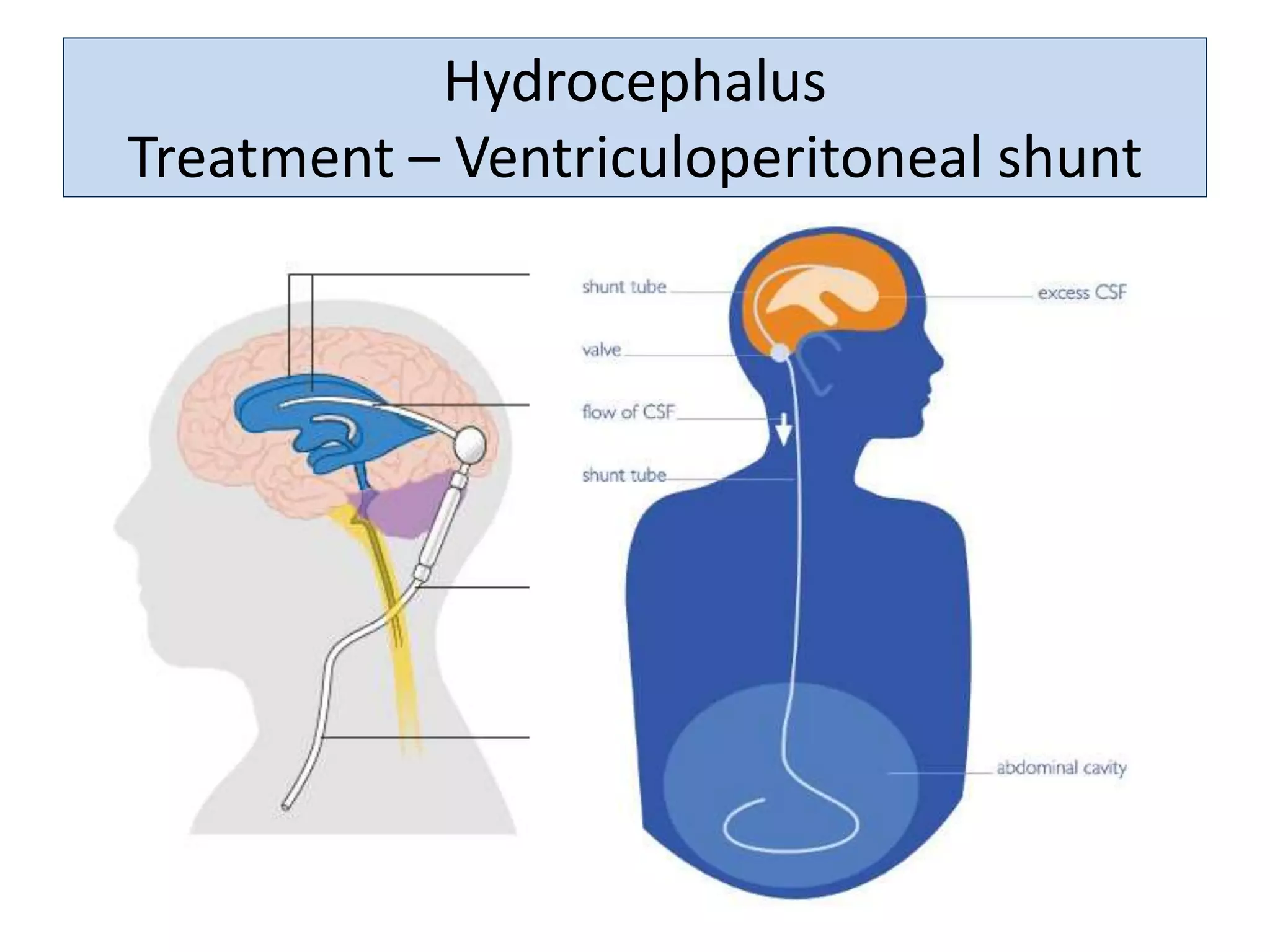 Hydrocephalus
Treatment – Ventriculoperitoneal shunt
 
