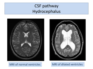 CSF pathway
Hydrocephalus
MRI of normal ventricles MRI of dilated ventricles
 