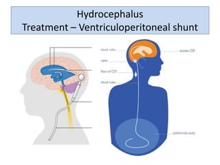 Hydrocephalus
Treatment – Ventriculoperitoneal shunt
 