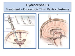 Hydrocephalus
Treatment – Endoscopic Third Ventriculostomy
 