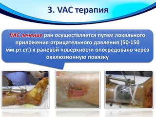 VAC лечение ран осуществляется путем локального
приложения отрицательного давления (50-150
мм.рт.ст.) к раневой поверхности опосредовано через
окклюзионную повязку
 