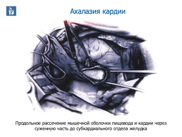 Центральное отверстие гранта