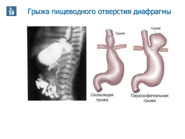 Фундопликация флоппи ниссан