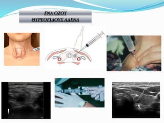 FNA ΟΖΟΥ
ΘΥΡΕΟΕΙΔΟΥΣ ΑΔΕΝΑ
 