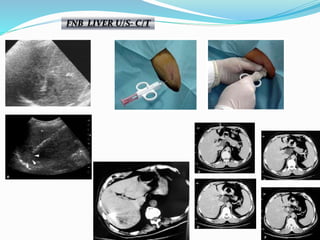 FNB LIVER U/S- C/T
 