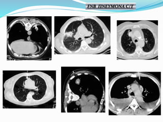 FNB ΠΝΕΥΜΟΝΑ C/T
 