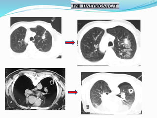 FNB ΠΝΕΥΜΟΝΑ C/T
 