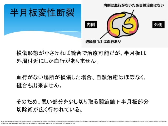 16 11 4 中年者の半月板変性断裂における運動療法vs関節鏡下半月板部分切除